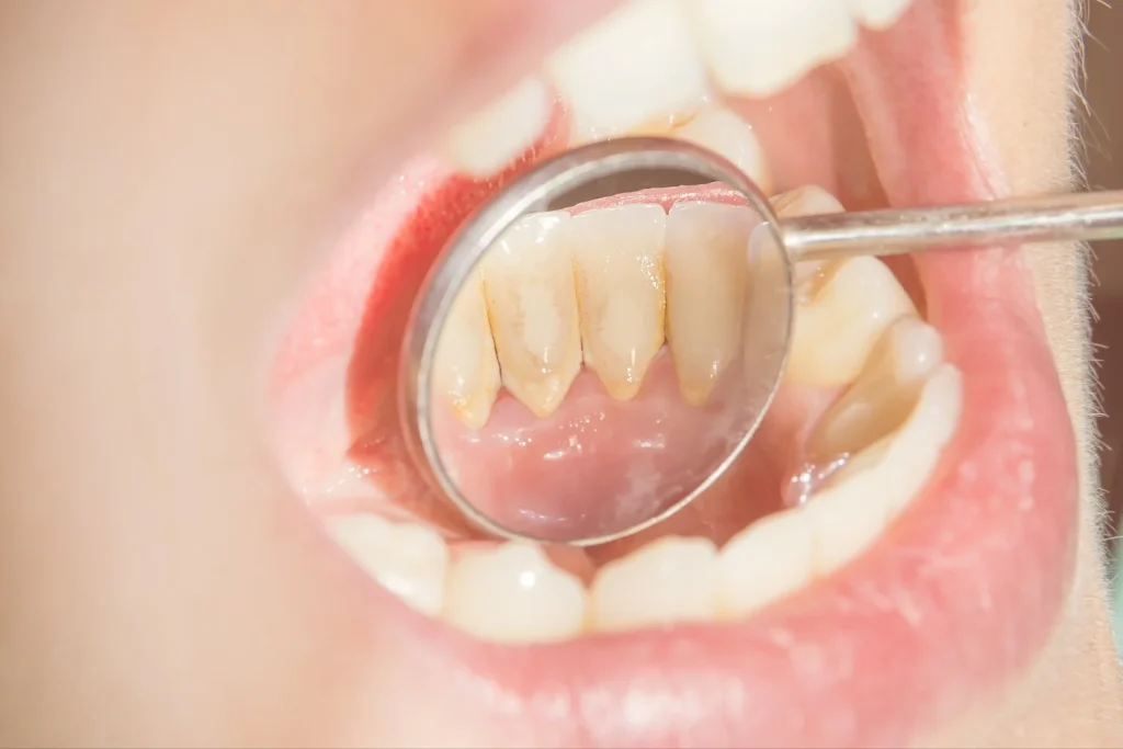 Dental Calculus: Types, Treatment and Prevention